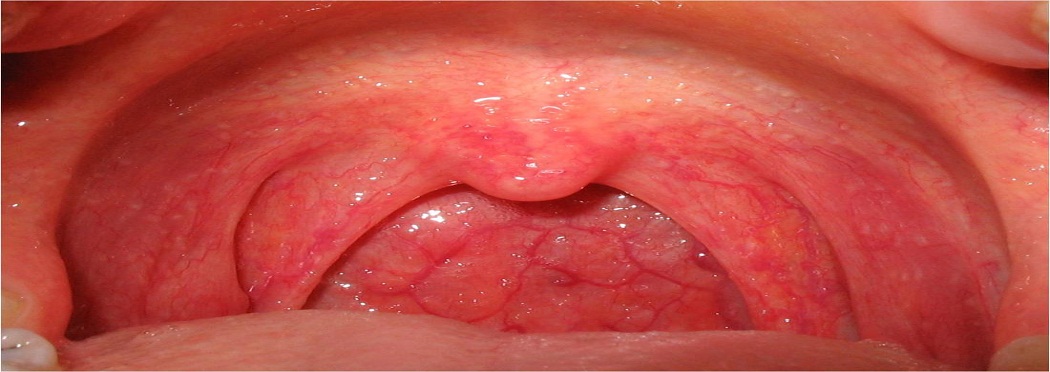 Laser tonsillectomy