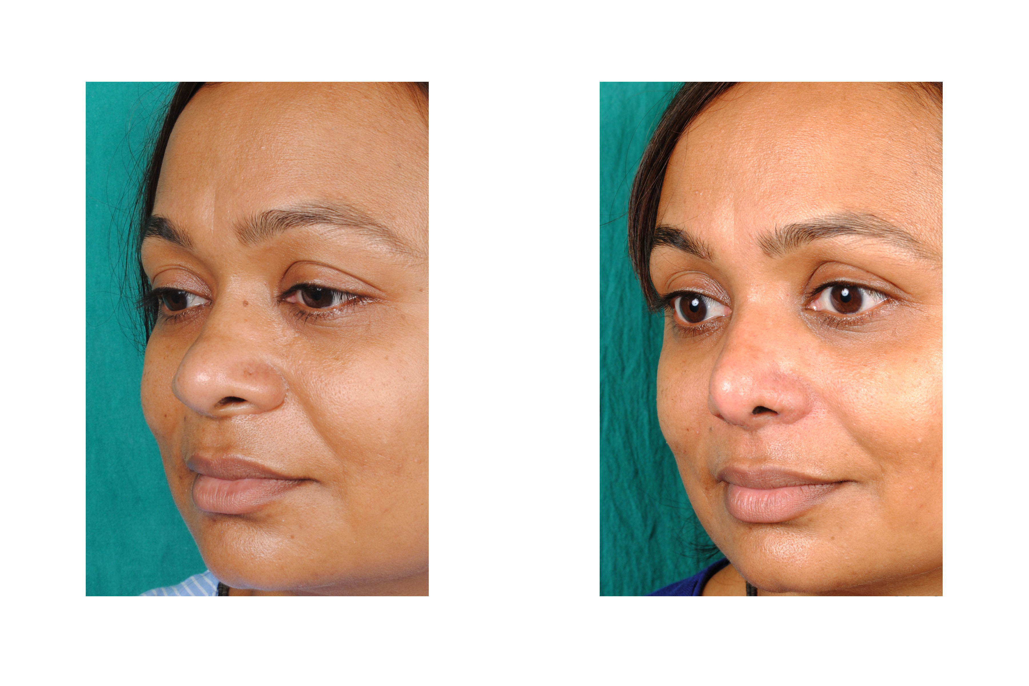 Nose specialist in anand Gujarat